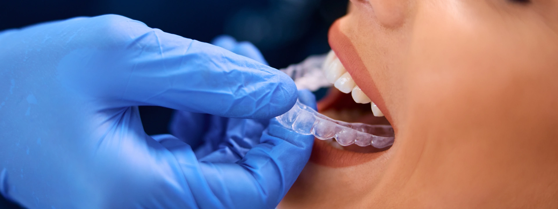 Invisalign tedavisi bittikten sonra dişlere sabitleyici (retainer) takılması gerekiyor mu?