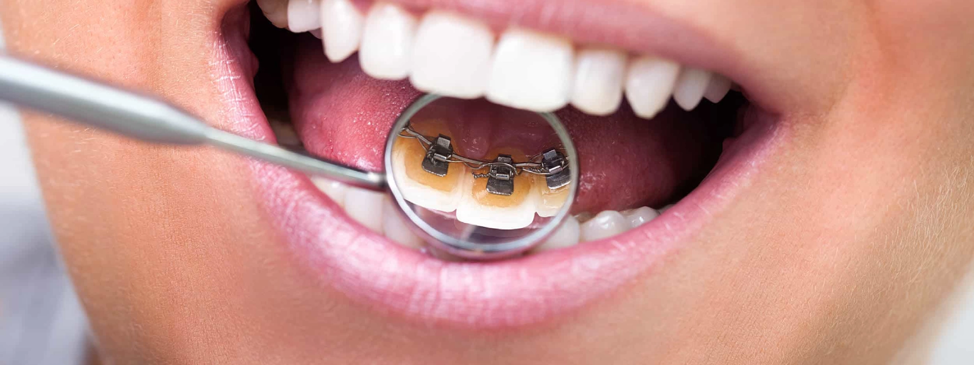 Lingual Diş Telleri Eski Braketlerden Farklı Olarak Konuşmayı Etkiler mi?