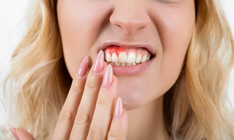 Diş Fırçalarken Diş Eti Kanaması Normal Mi?