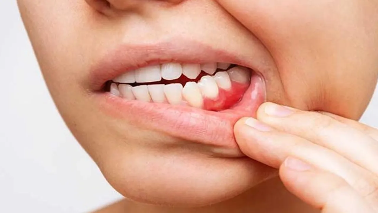 Diş Eti Çekilmesi Durur mu, İlerler mi?